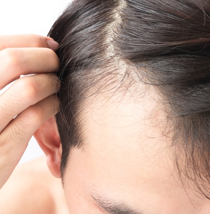 薄毛の悩みに効果的な予防方法　ヘアフィラーとは何かご紹介します　